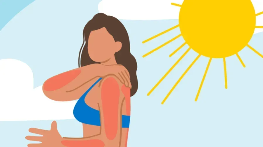Illustration of a woman with sunburned shoulders under a bright sun
